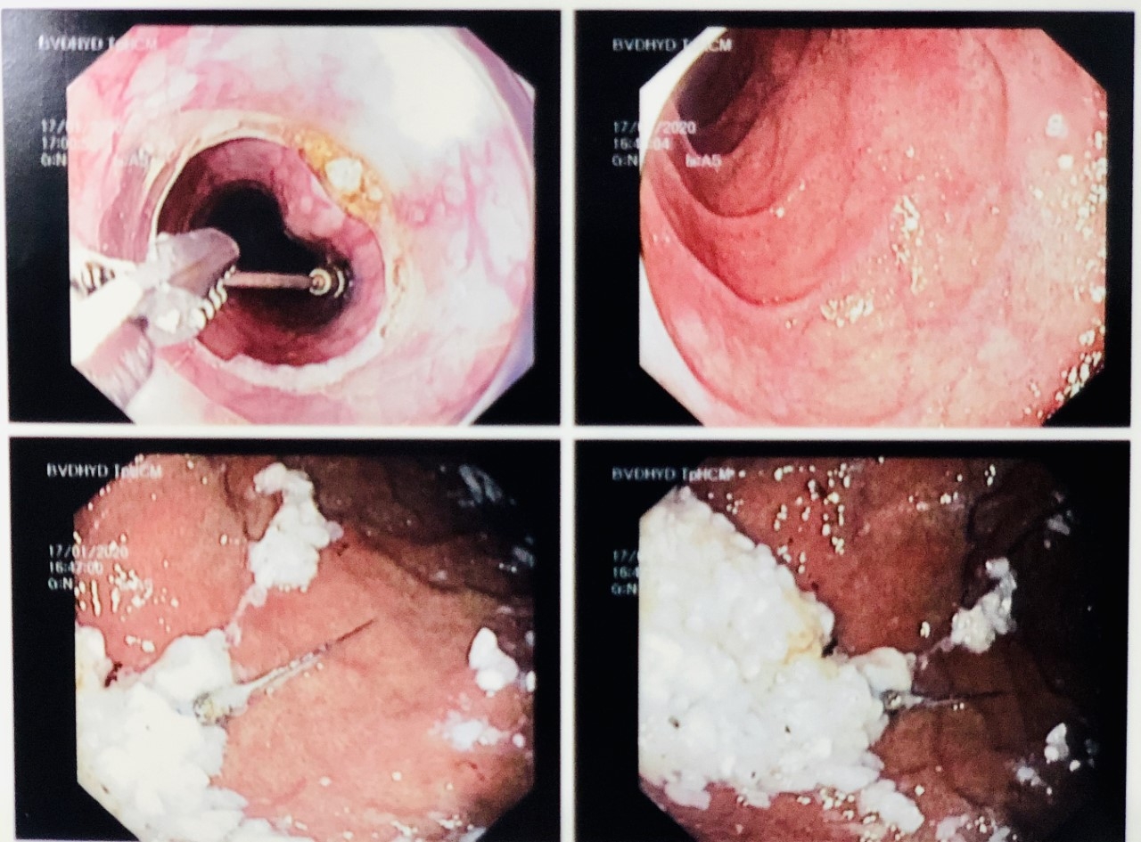 gap thanh cong mui kim nha khoa ra khoi da day benh nhan