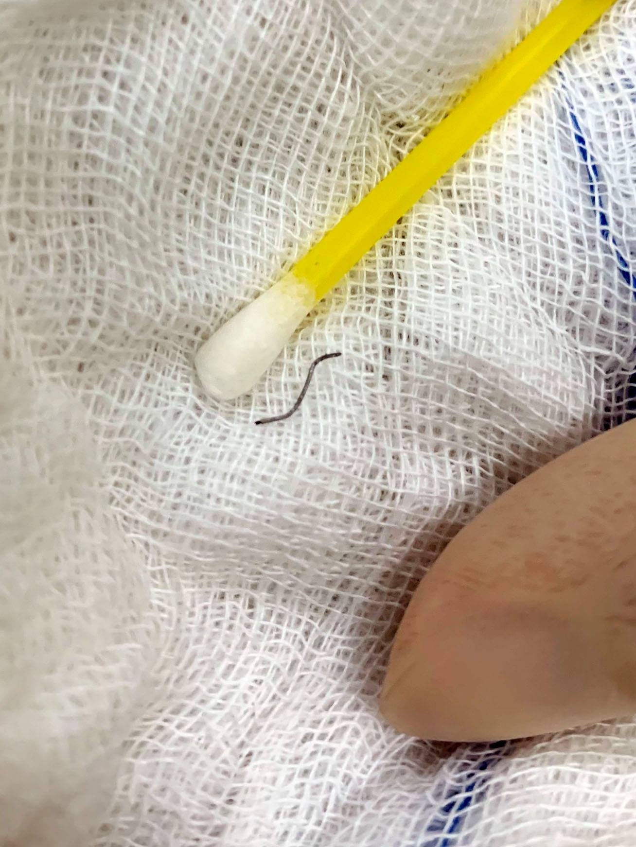 Dị vật được lấy ra 5131-121685739-1765589980274836-9103319336115046431-o