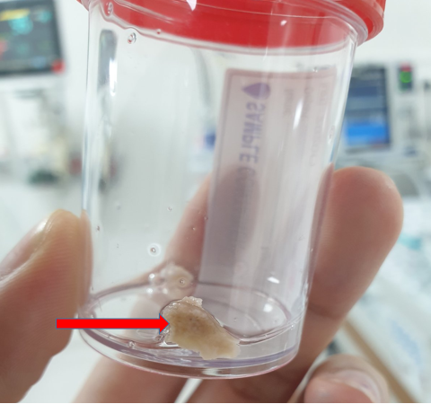 Mảnh xương heo hình tam giác có cạnh sắc nhọn cắm vào phế quản gốc bên trái và mảnh xương nhỏ khác Mảnh xương heo hình tam giác có cạnh sắc nhọn cắm vào phế quản gốc bên trái và mảnh xương nhỏ khác