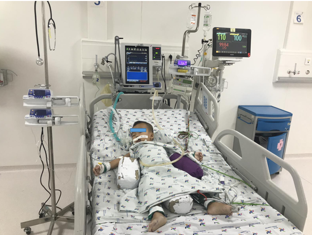 Trẻ 20 tháng tuổi, hóc xương heo đường thở gây suy hô hấp nặng, được nội soi cấp cứu lấy dị vật và được tiếp tục điều trị tại Khoa Hồi sức ngoại. Trẻ 20 tháng tuổi, hóc xương heo đường thở gây suy hô hấp nặng, được nội soi cấp cứu lấy dị vật và được tiếp tục điều trị tại Khoa Hồi sức ngoại.